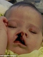 Baby with wires in mouth to help reduce cleft in palate before surgery.