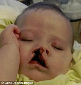 Baby with wires in mouth to help reduce cleft in palate before surgery.
