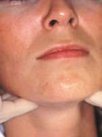 Checking the face for oral cancer signs.