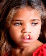 Pretty little girl with brown hair and open cleft lip permanently revealing tooth .