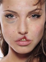 Angelina Jolie with cleft lip
