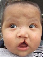 Child with cleft lip and palate.